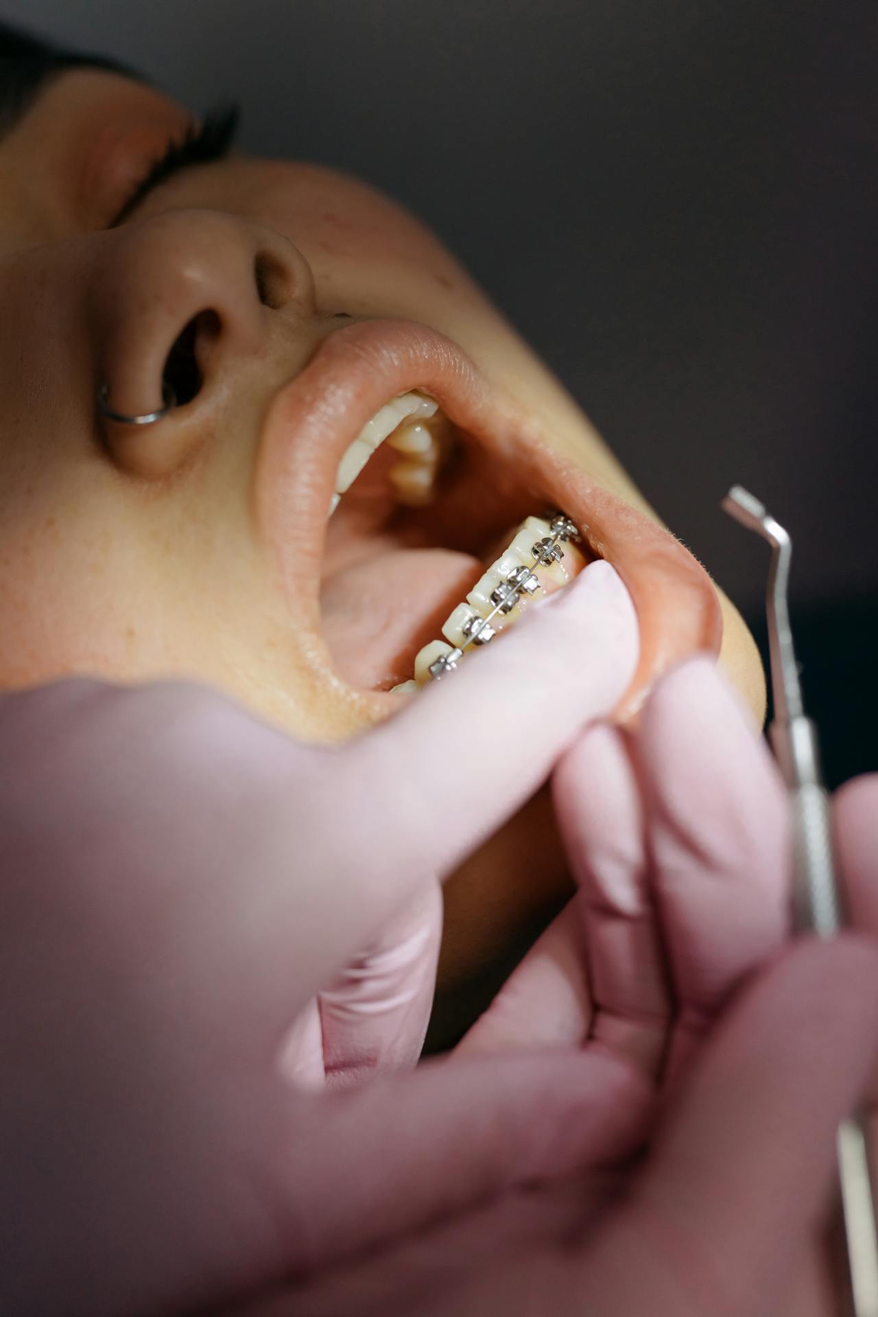 Ortodoncia Estética y Alineadores Dentales