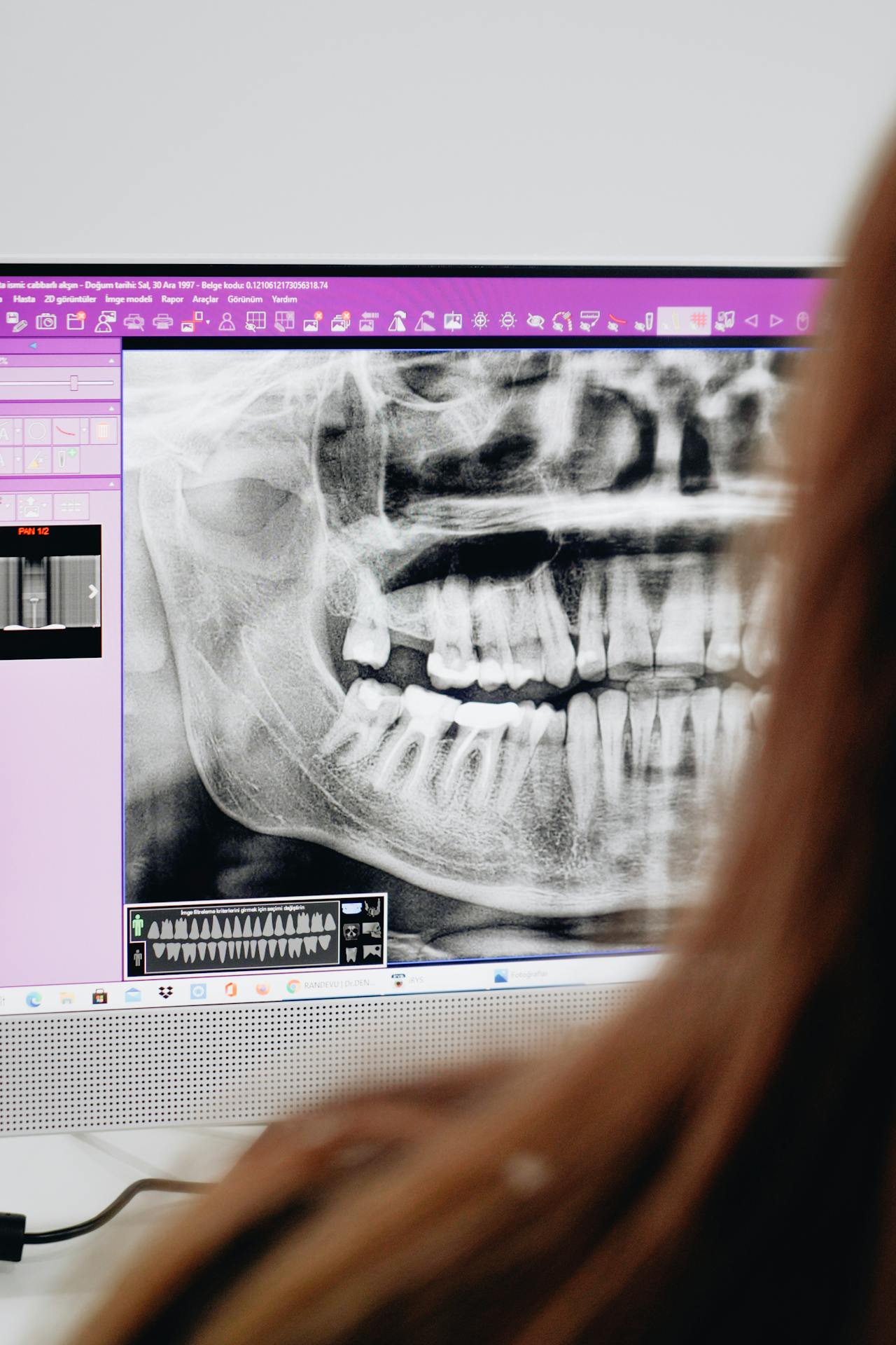 Implantes Dentales y Rehabilitación Integral
