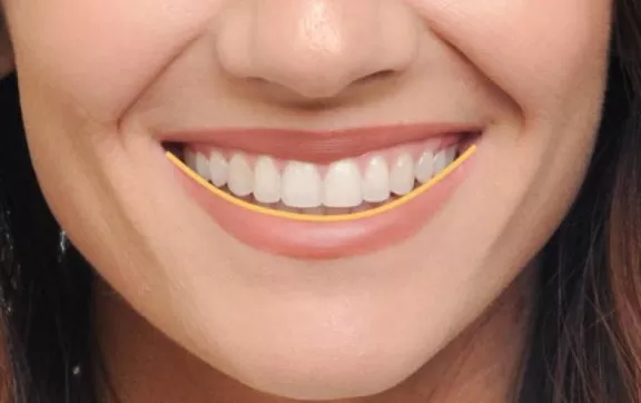Ejemplo de sonrisa Damon
